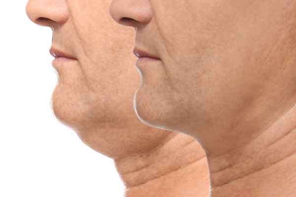 HIFU - Breakthrough in Anti - ageing 2 hifu results Hastings