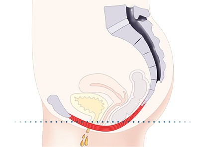 Pelvic-Floor Muscle Repair 5 Pelvic floor muscles Hastings