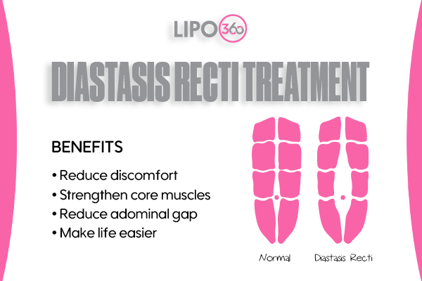 Revolutionising Muscle Repair: The Power of LIPO360 Body Sculpt Post-Injury 5 diastasis recti treatment Hastings