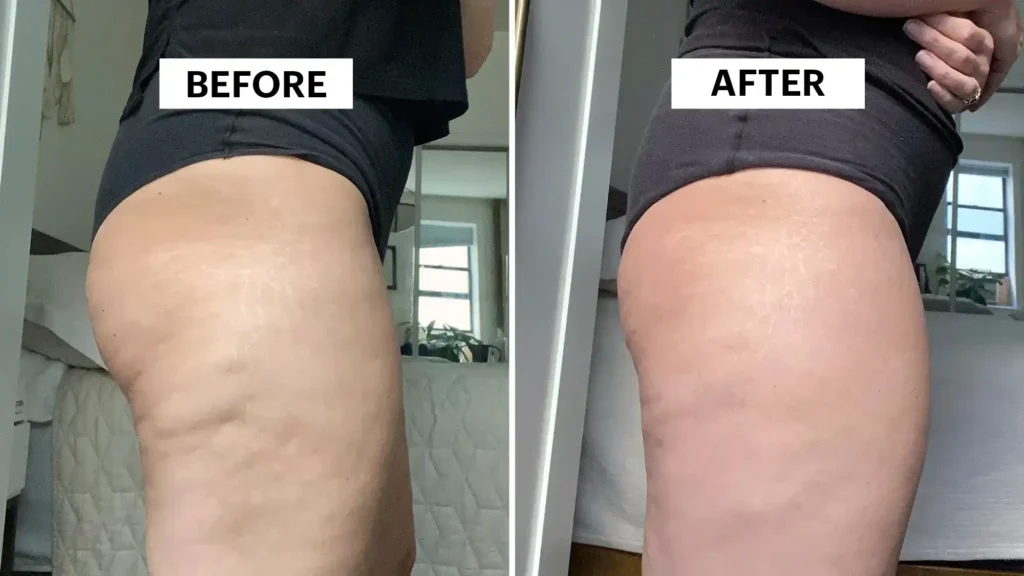 Sculpting Your Bum: Can Toning Exercises Really Reduce Cellulite? 1 Do Toning Exercise Hastings Really Tackle Cellulite?