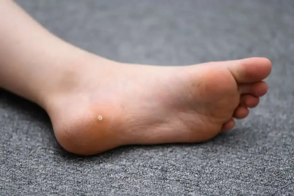 Cryotherapy For Warts And Also Verrucas 2 Image of verruca on the bottom of the foot that able to be treated with Cryotherapy Hastings