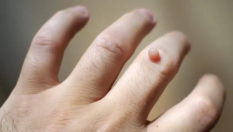 Cryotherapy For Warts And Also Verrucas 1 Image of blemish that Cryotherapy Hastings can remove with Lipo 360.