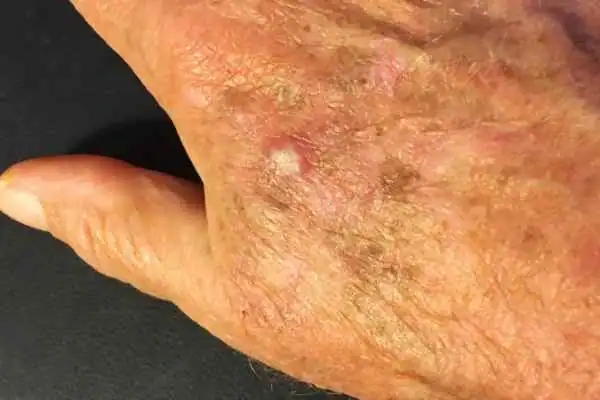 Cryopen For Actinic Keratoses 1 Image of Actinic keratoses Hastings on a person hand