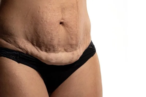 The Science of Skin Tightening 1 The science behind skin tightening Hastings picture of a woman's sagging skin on the stomach